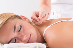 Acupuncture/Dry Needling