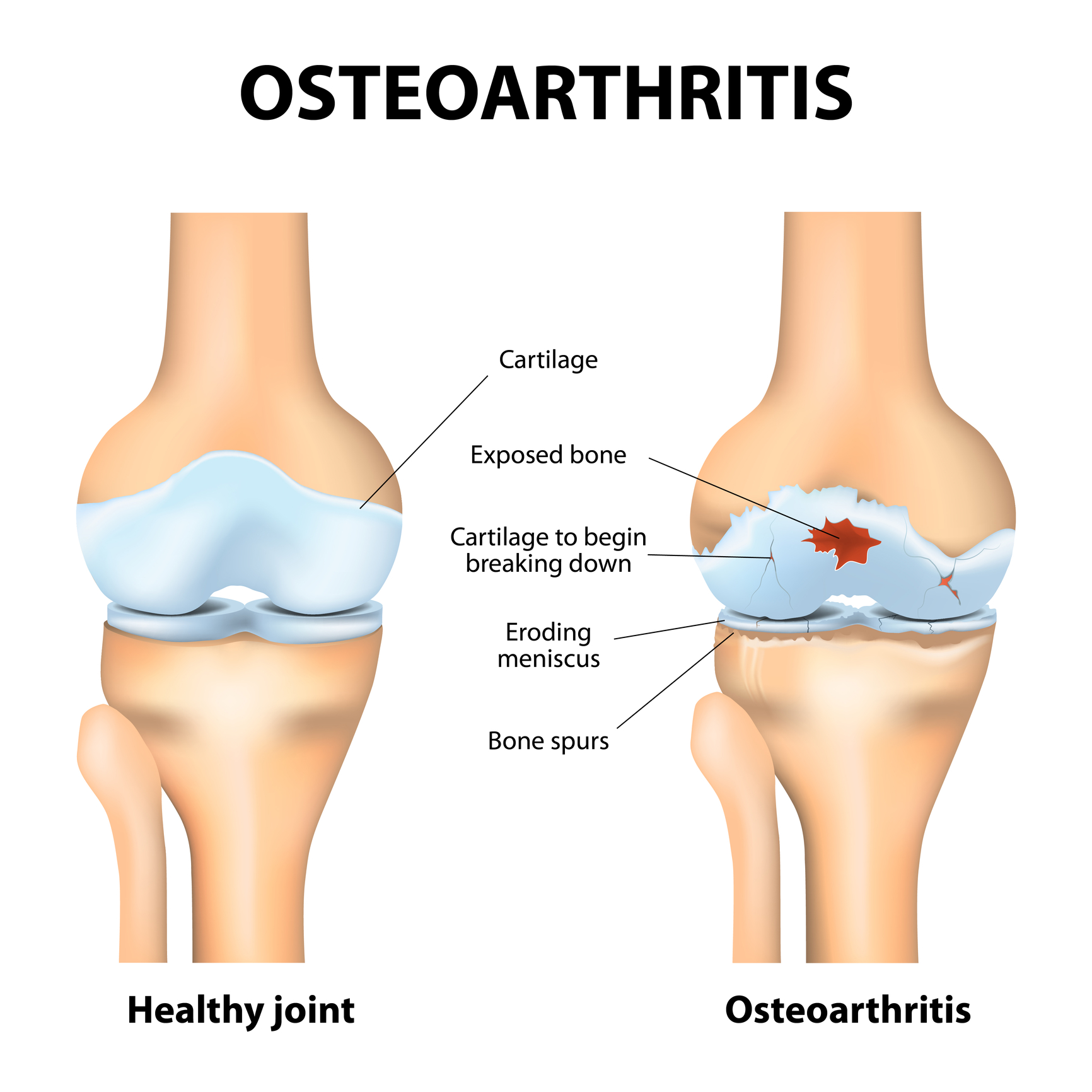 Остеоартроз 1 2 степени коленного сустава. Деформирующий артроз коленного сустава степени. Деформирующий остеоартроз коленного сустава (гонартроз). Остеоартрит (артроз, дегенеративные заболевания суставов). Деформирующий остеоартрит коленного сустава.